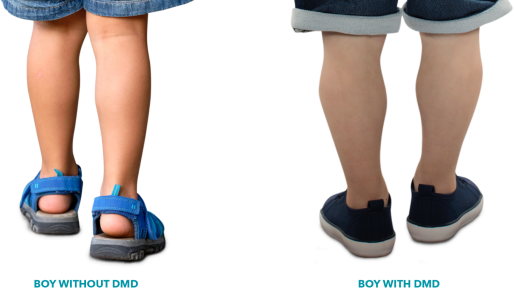 Calf muscles of a healthy boy versus a boy with DMD